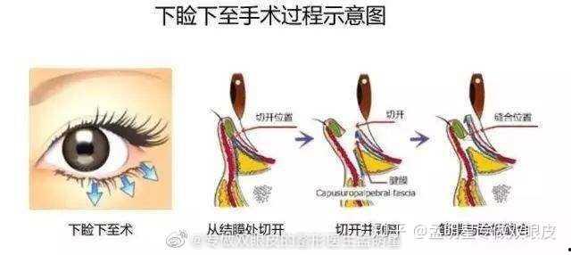 孟明星双眼皮术后,美丽蜕变，见证自信新生